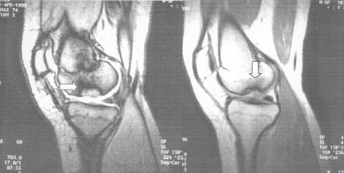 рендгенски снимак дисекане остеохондрозе у коленском зглобу