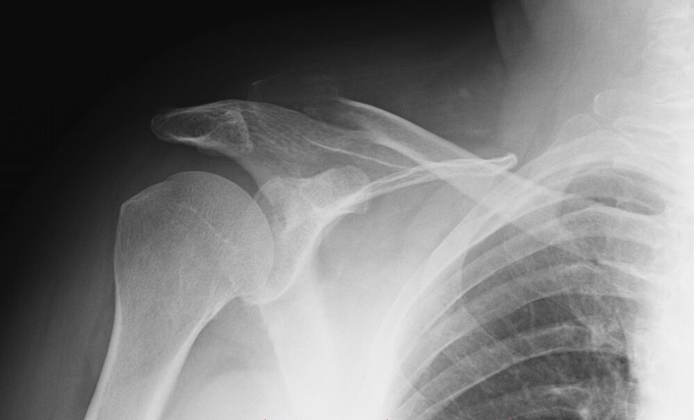 рендгенски снимак артрозе рамена